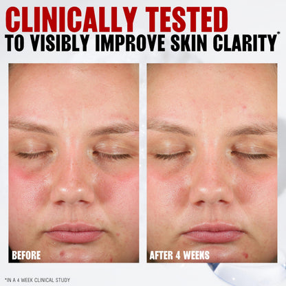 Thayers Blemish Clearing Acne Pads, Salicylic Acid Acne Treatment for Face, Pore Reducing, Exfoliating, and Soothing Skincare, Witch Hazel Toner Pads, 60 Ct