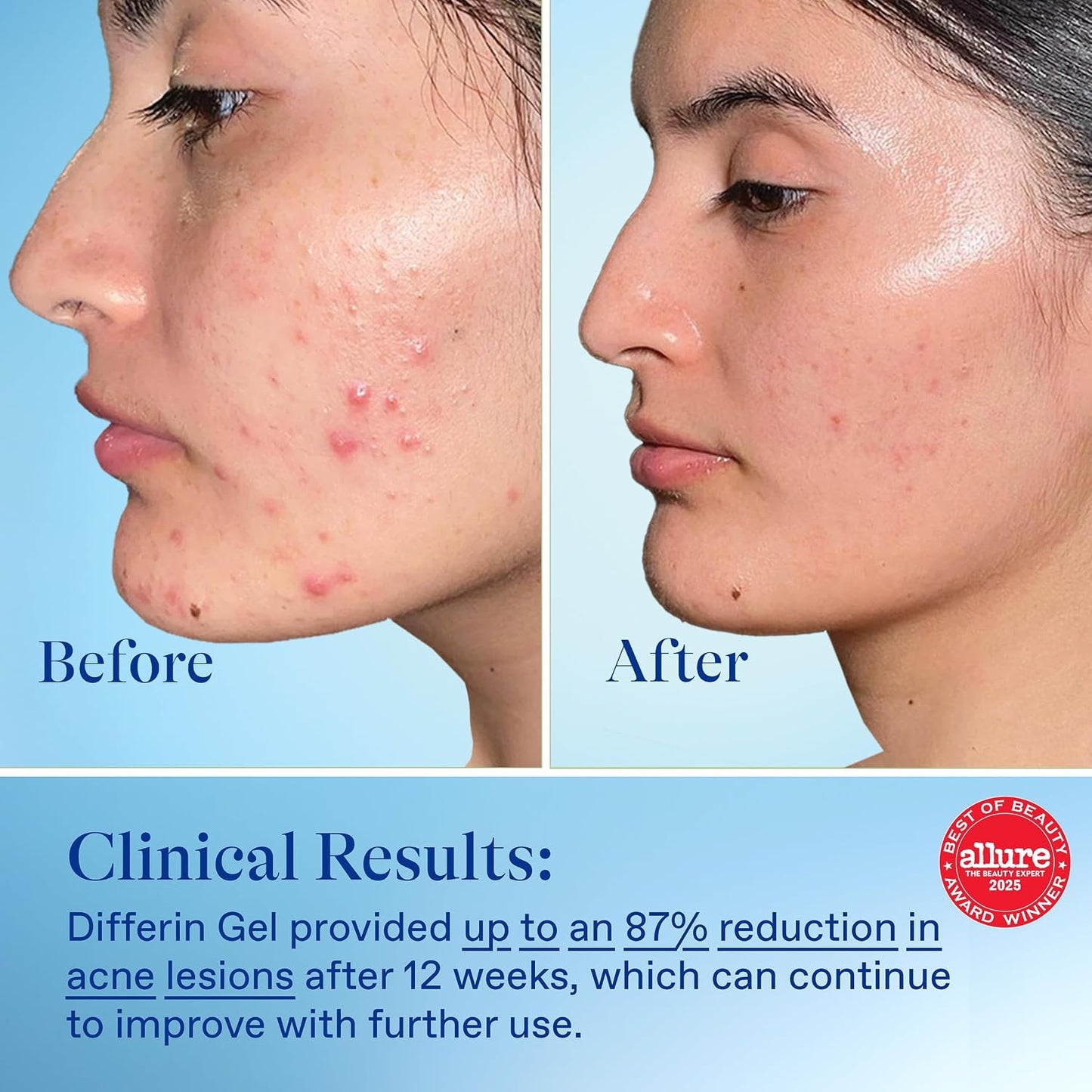 Differin Acne Retinoid Treatment Gel, 0.1% Adapalene, 45g Pump