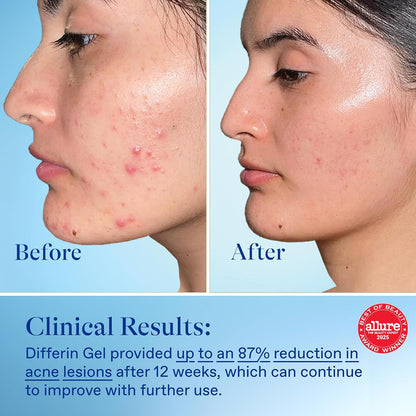 Differin Acne Retinoid Treatment Gel, 0.1% Adapalene, 45g Pump