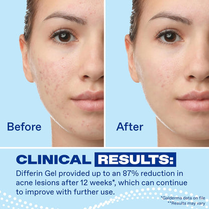 Differin Acne Retinoid Treatment Gel, 0.1% Adapalene, 45g Pump