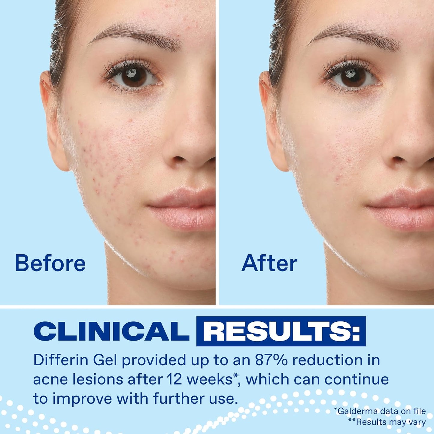 Differin Acne Retinoid Treatment Gel, 0.1% Adapalene, 45g Pump