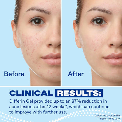 Differin Acne Retinoid Treatment Gel, 0.1% Adapalene, 45g Pump